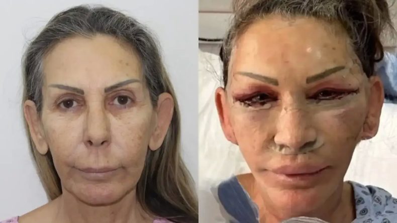 Petek Dinçöz'ün Annesi Estetik Ameliyatı Geçirdi: Son Durumu Şaşırtıyor