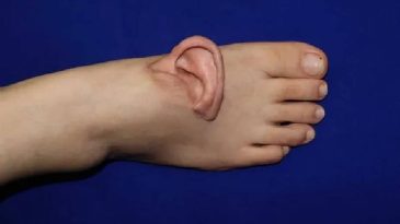 D&uuml;nya&rsquo;da Bir İlk: Doktorlar Kulağı Yaşatmak İ&ccedil;in Ayağa Dikti