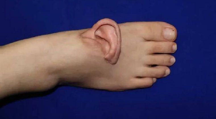 D&uuml;nya&rsquo;da Bir İlk: Doktorlar Kulağı Yaşatmak İ&ccedil;in Ayağa Dikti