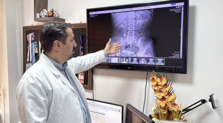 İdrar Kanalından 51 Taş &Ccedil;ıkarıldı!